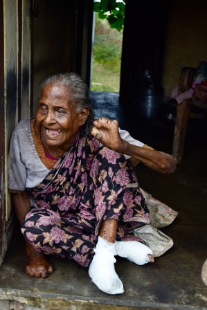 The debilitating and highly-visible deformities of leprosy have left this patient unable to walk or see, and with extremely limited use of her hands. She lives alone, in a very remote area.